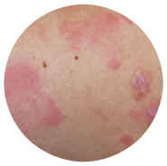 pomfi sintomi dell'orticaria cronica spontanea